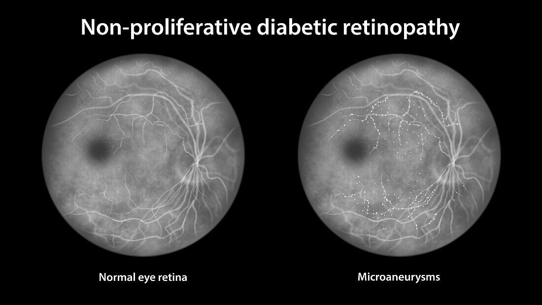 Retina damage from diabetes, illustration