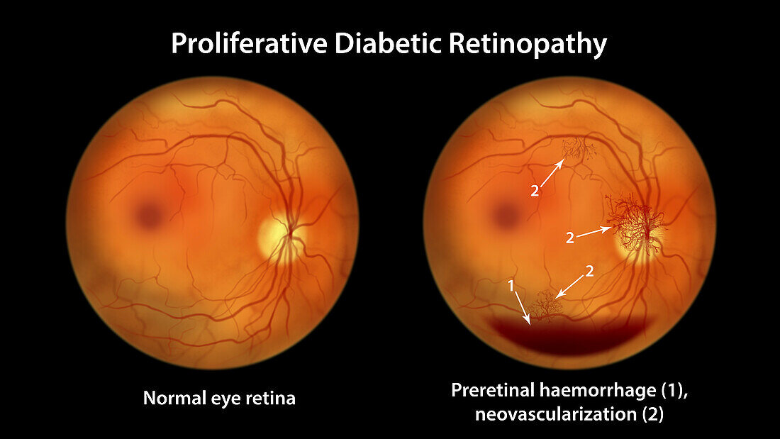 Retina damage from diabetes, illustration