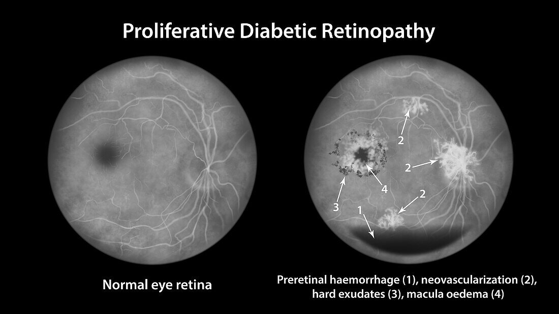 Retina damage from diabetes, illustration