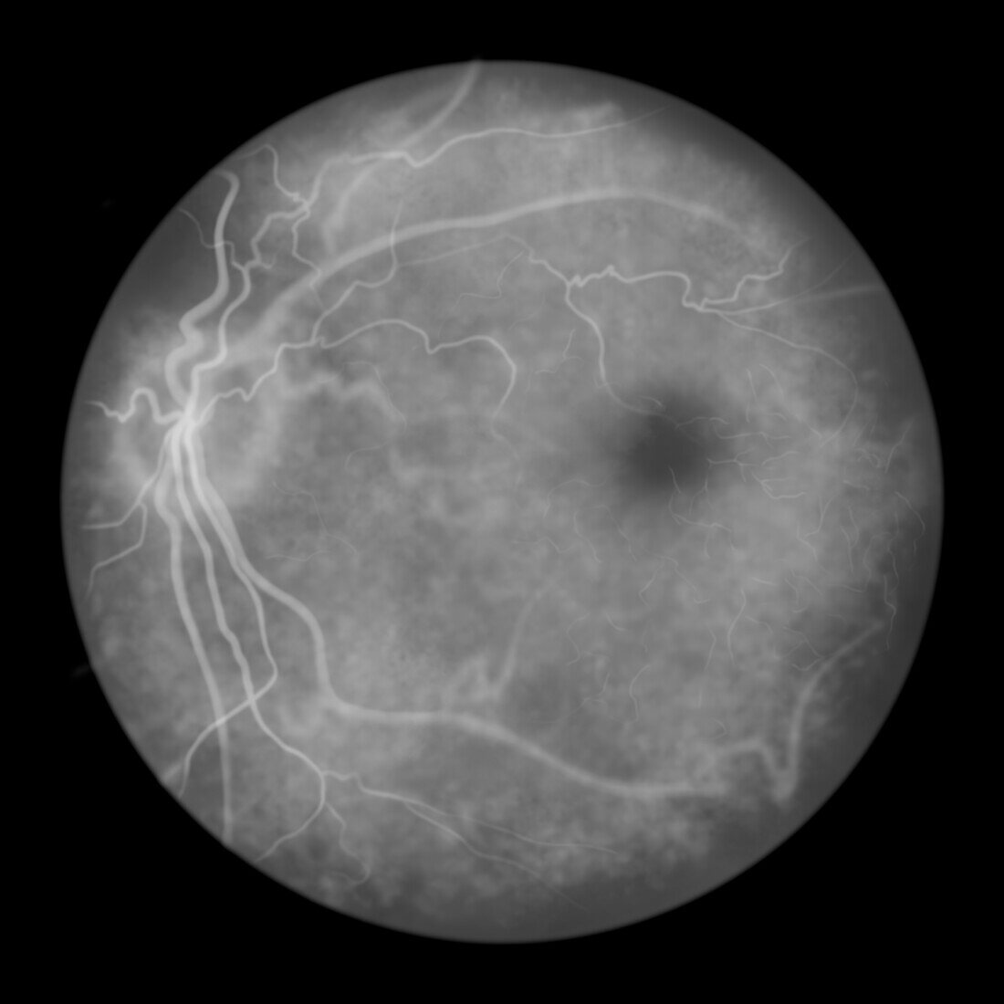 Fluorescein angiogram of a retina, illustration