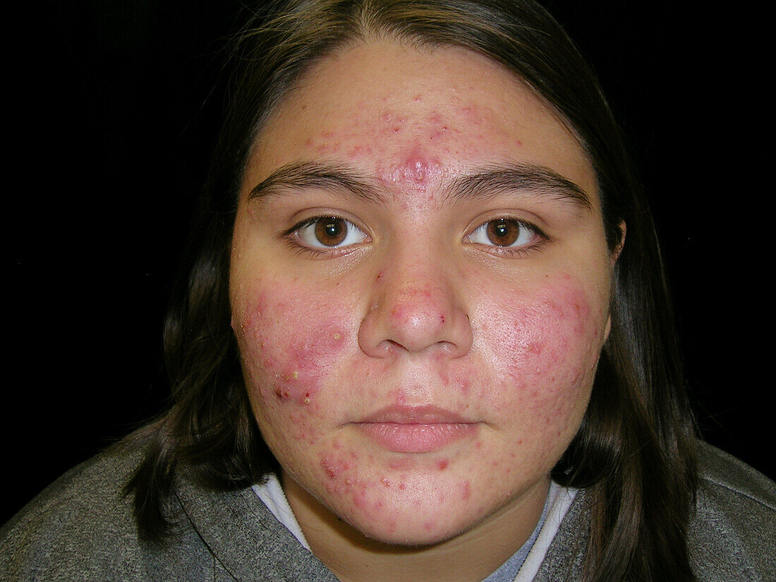 Cystic acne