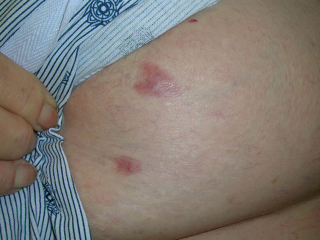 Keloid scar