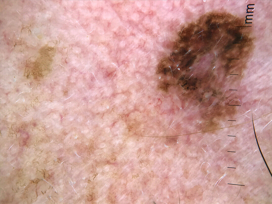 Melanoma in situ, dermoscopy