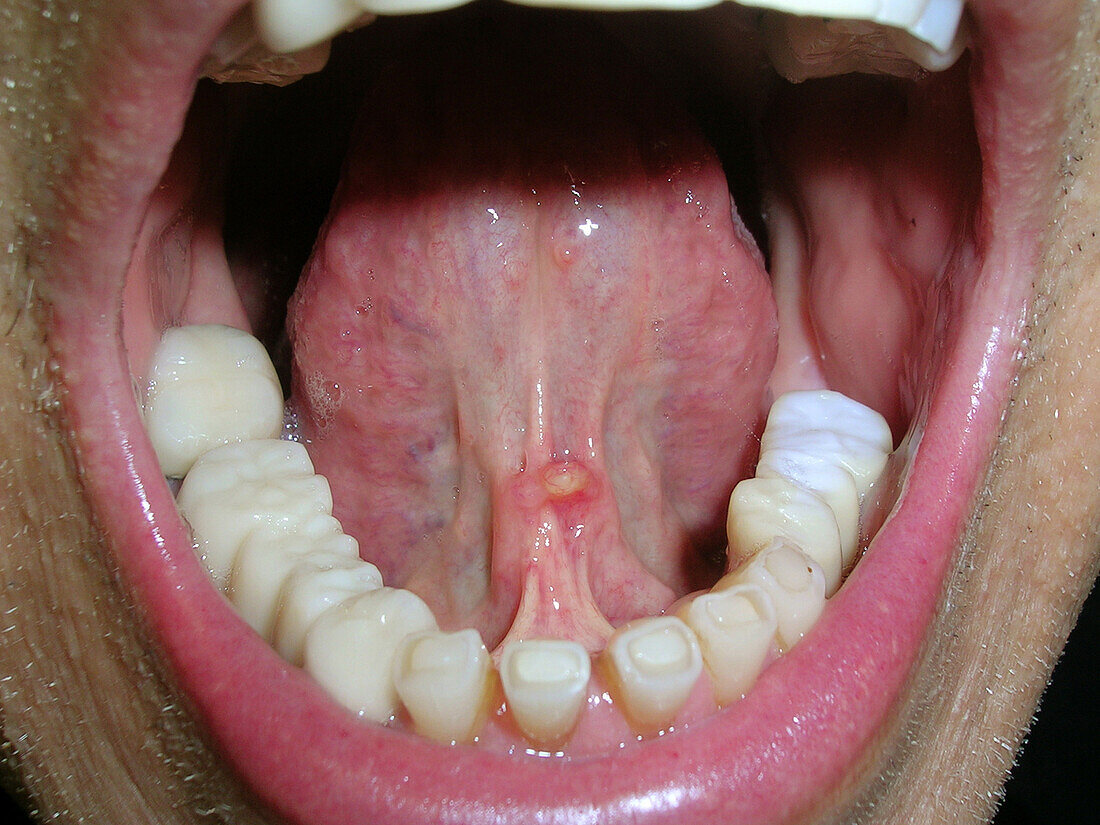 Mucocele under tongue