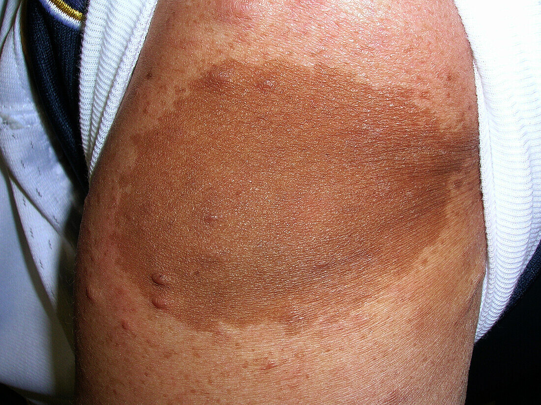 Recklinghausen's disease