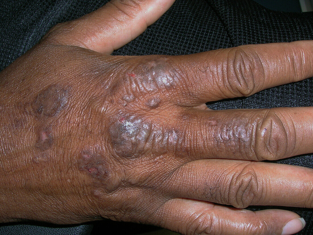 Lichen simplex chronicus