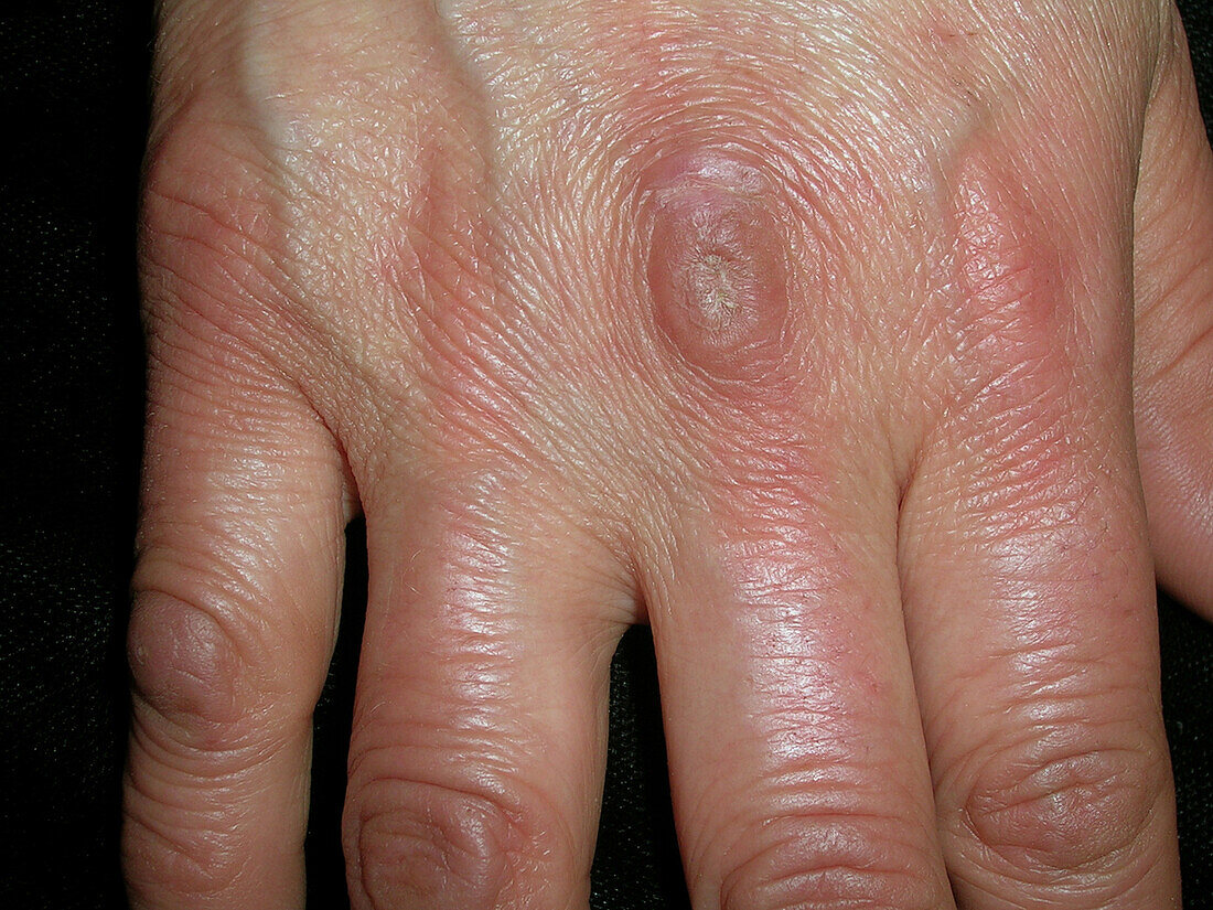 Gottron's papule in dermatomyositis