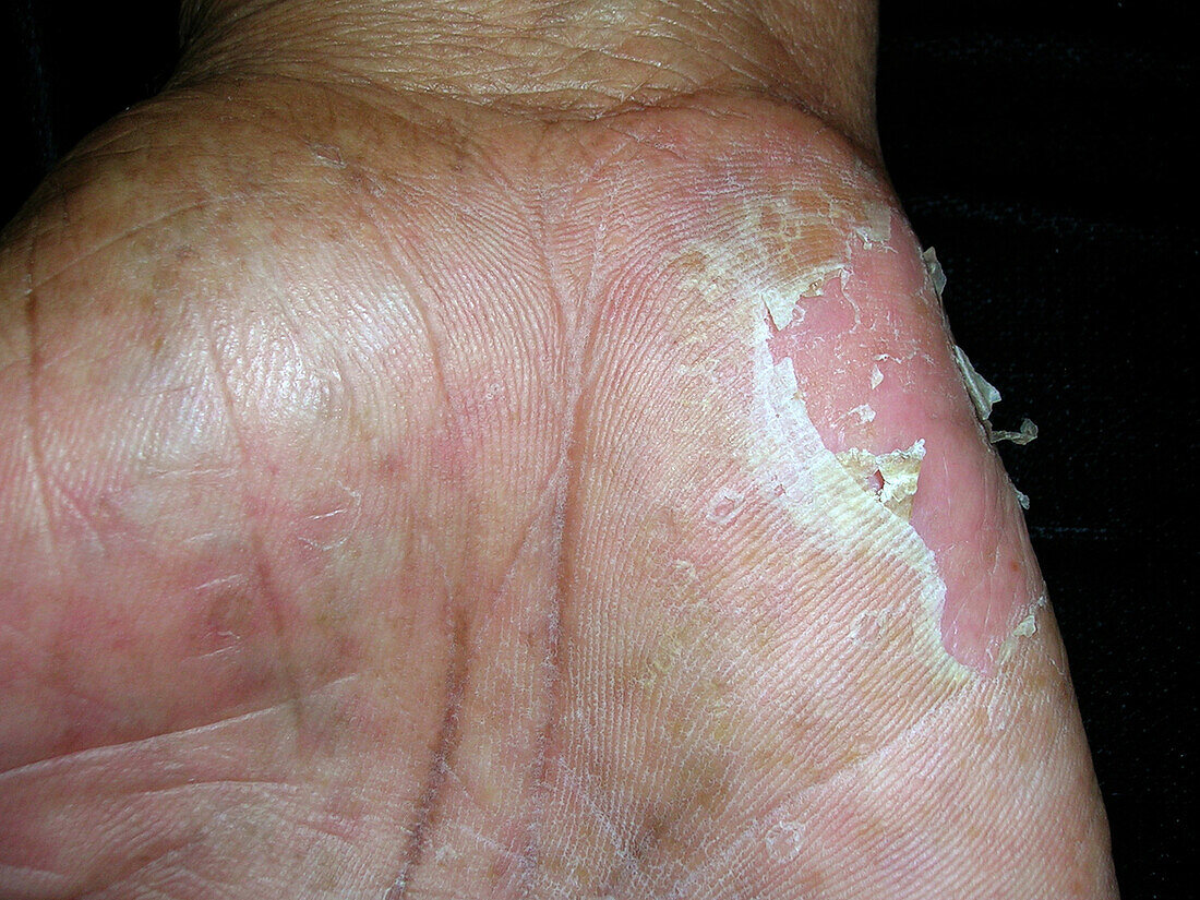 Dyshidrotic eczema