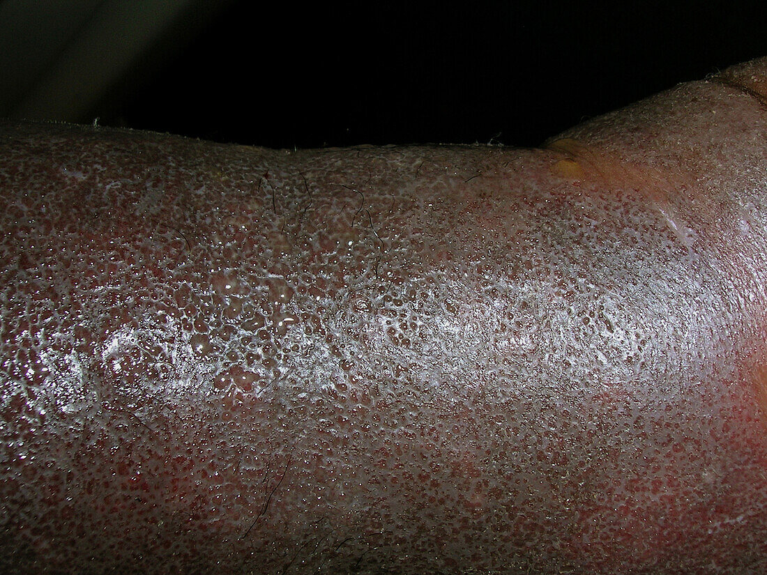 Severe eczema