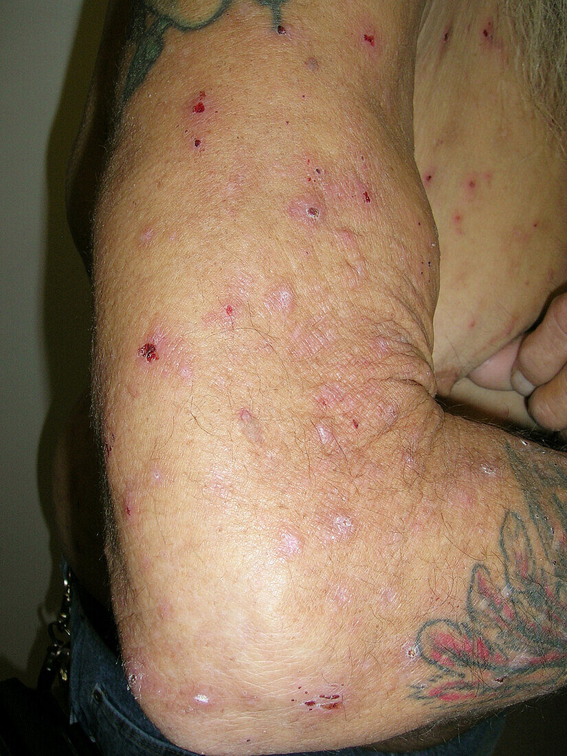 Scratching due to Hodgkin's lymphoma