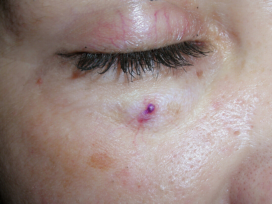 Spider angioma after electrosurgery