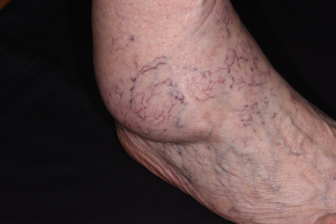 Swollen ankle in osteoarthritis