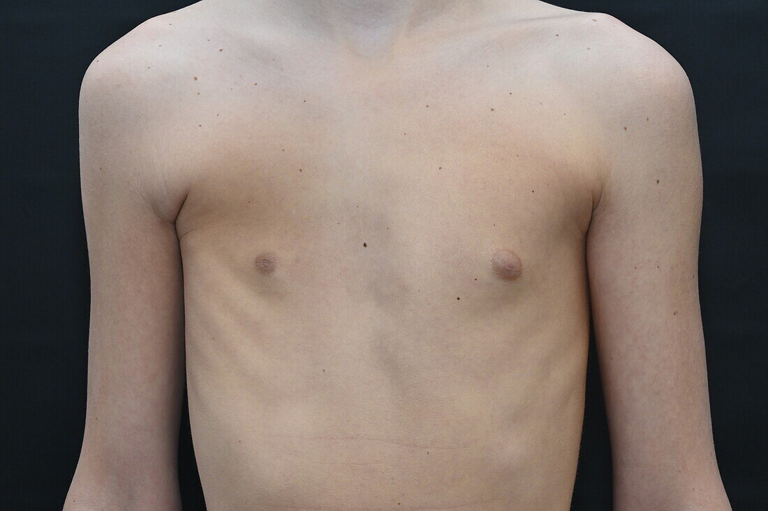 Congenital chest deformity