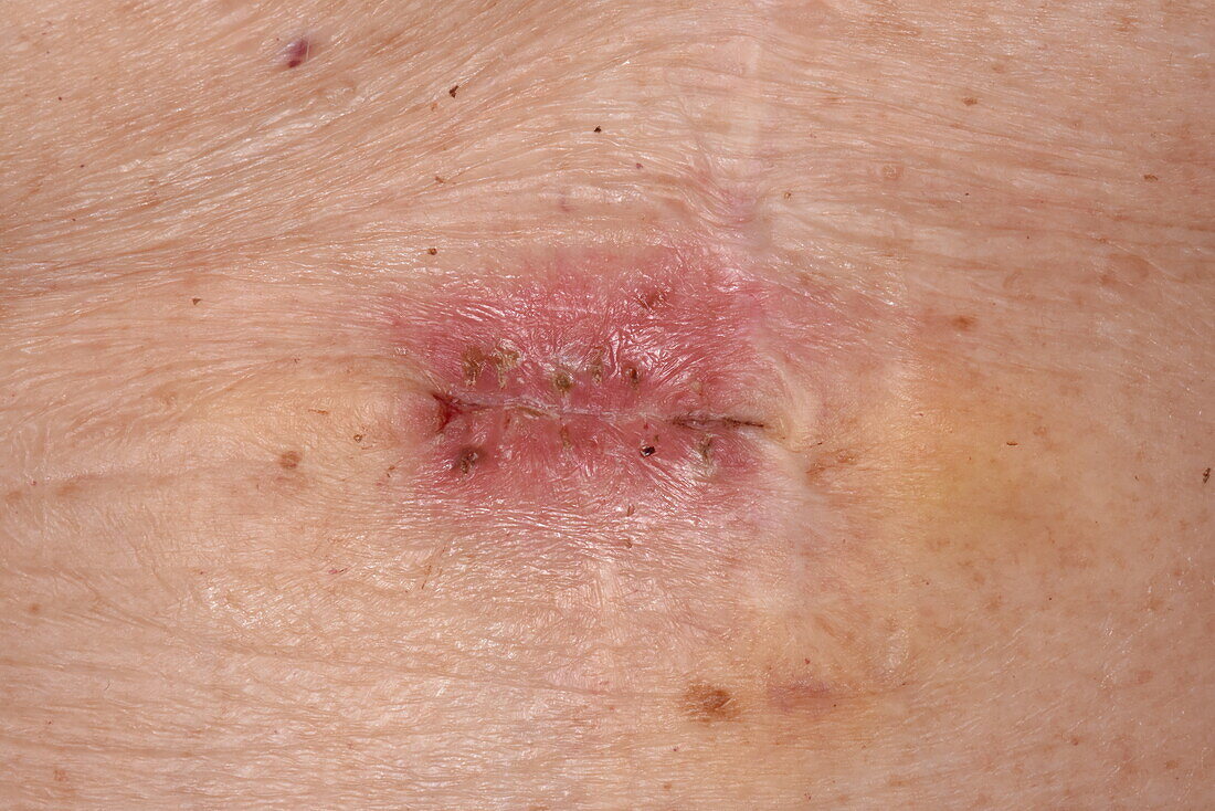 Scar after cancer removal