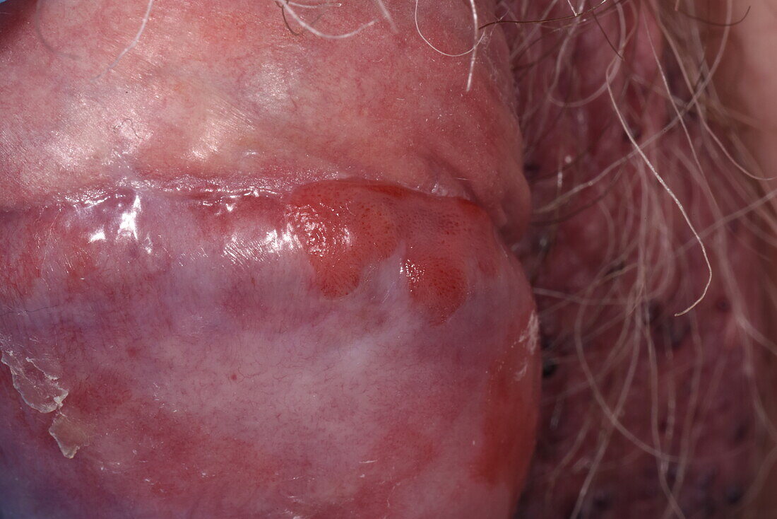 Penile intraepithelial neoplasia