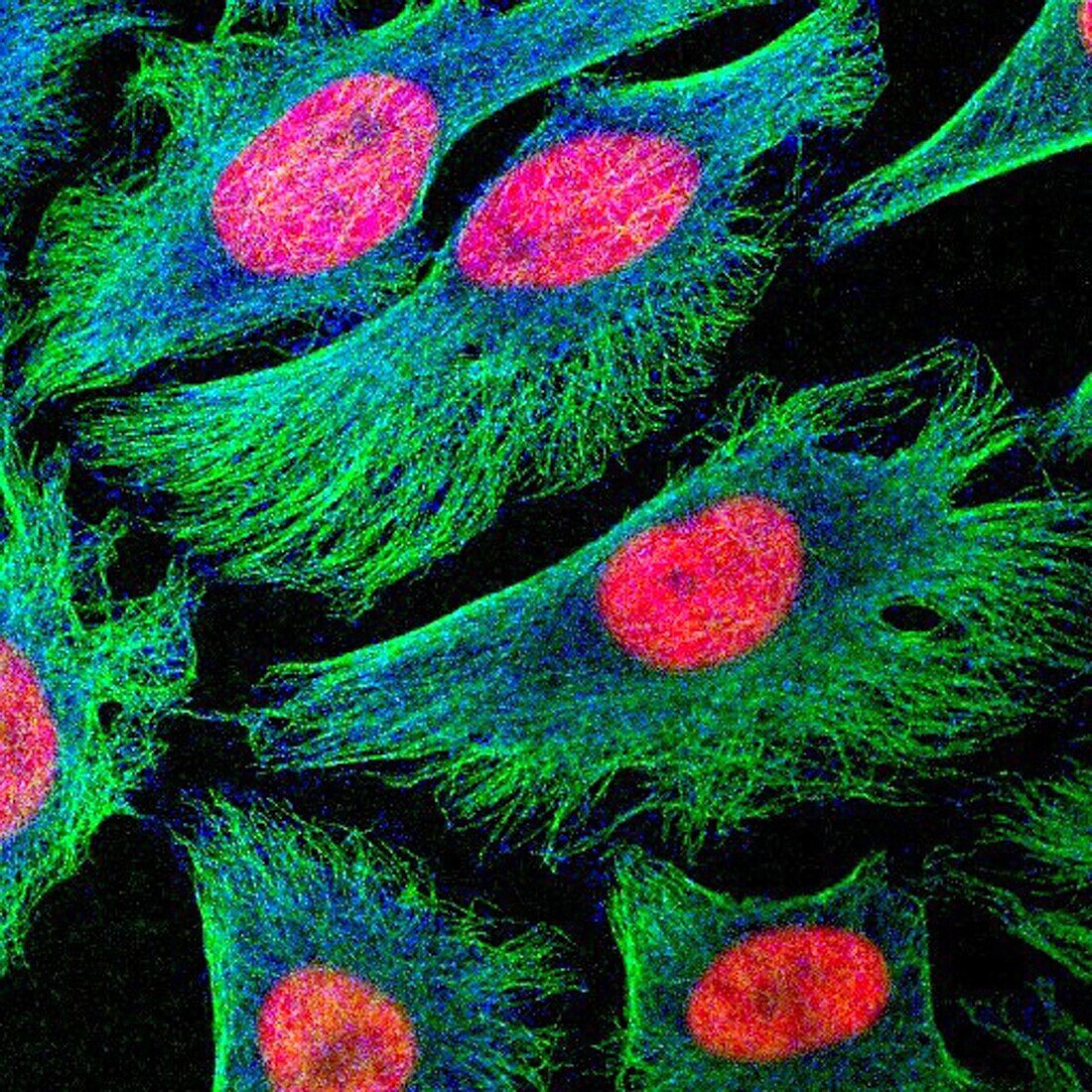 Human cancer cells in culture, light micrograph