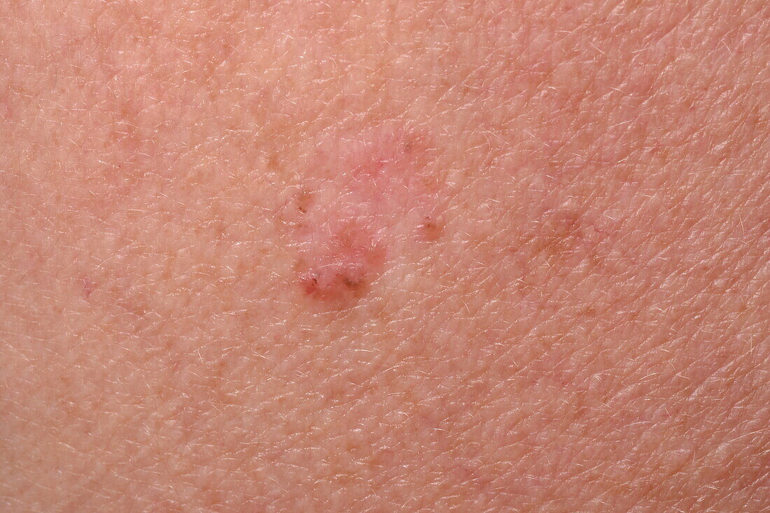 Superficial basal cell carcinoma