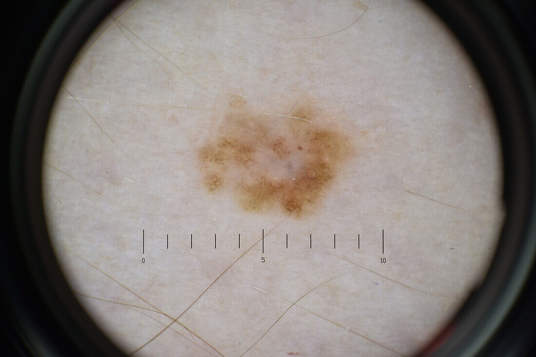 Melanoma in situ, dermatoscope image