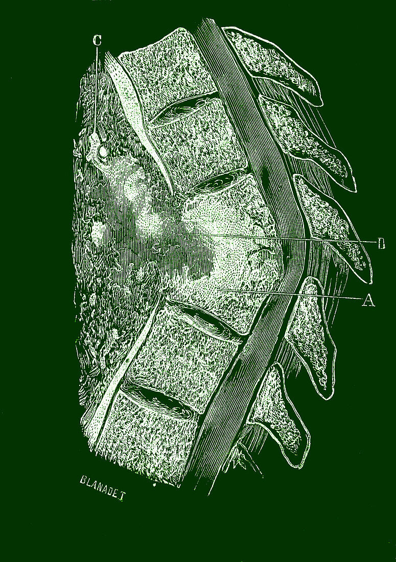 Melanoma from lungs spreading to the vertebra, illustration