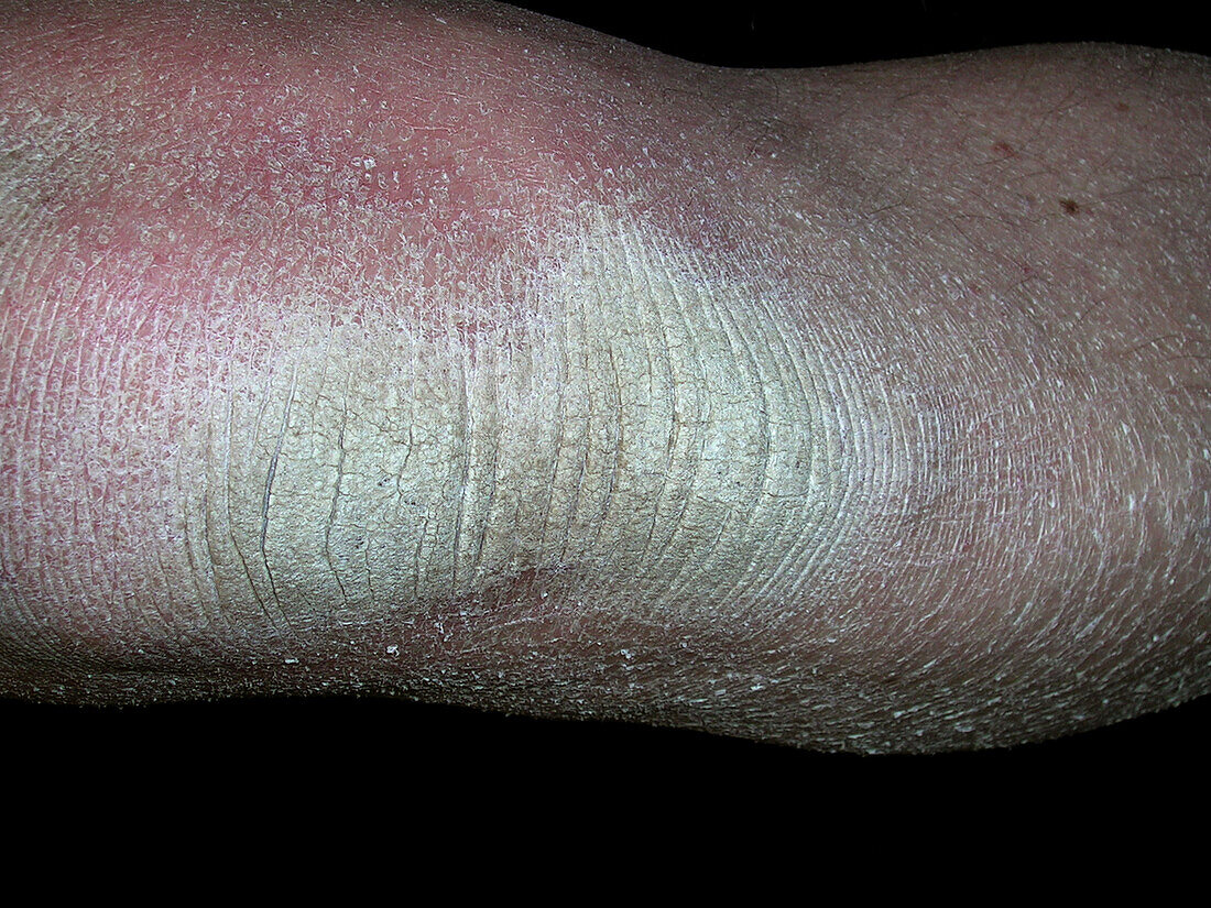 Acquired ichthyosis
