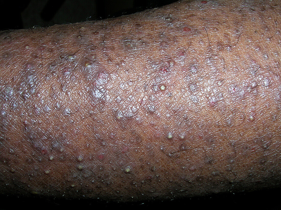 Infected atopic dermatitis