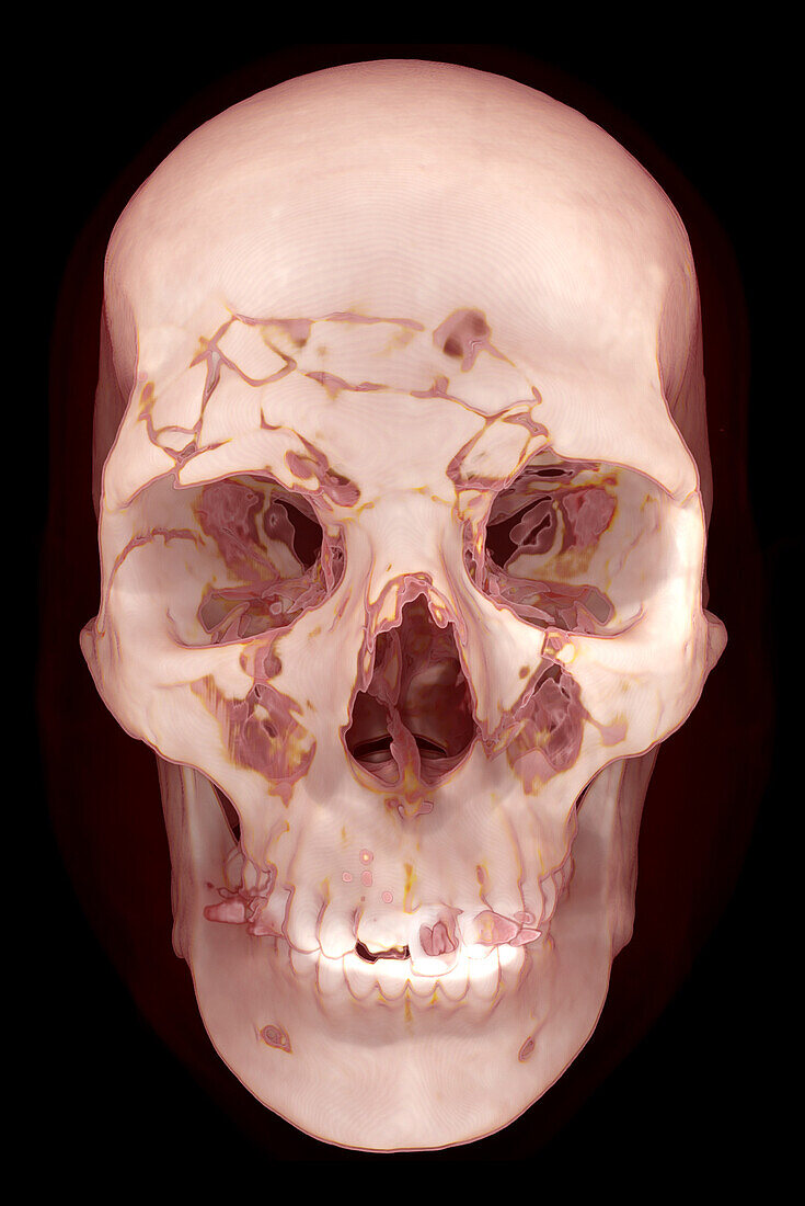 Skull fractures, CT scan
