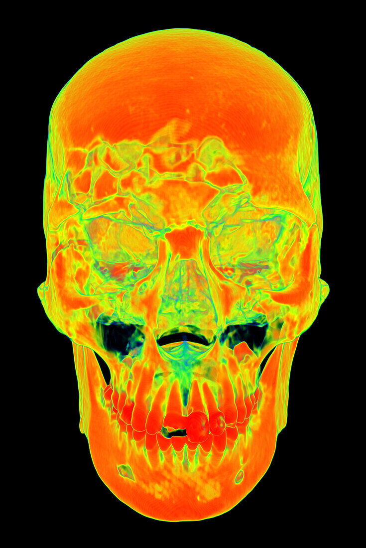 Face and skull fractures, CT scan