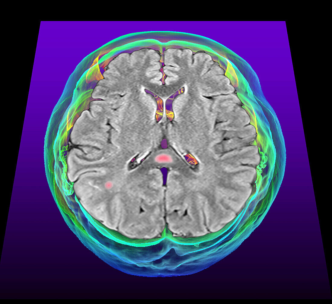 Multisystem inflammatory syndrome, MRI and 3D CT scans