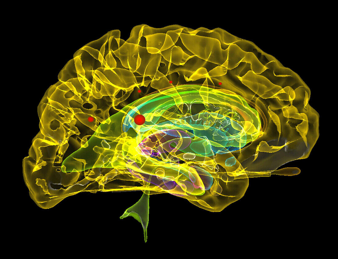 Multisystem inflammatory syndrome in adults, MRI scan