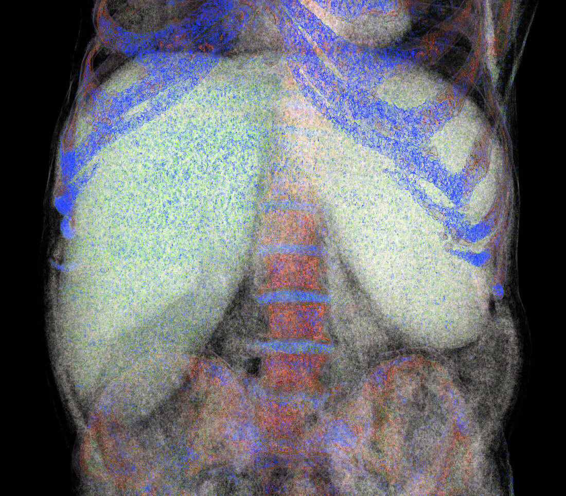 Hepatosplenomegaly, CT scan