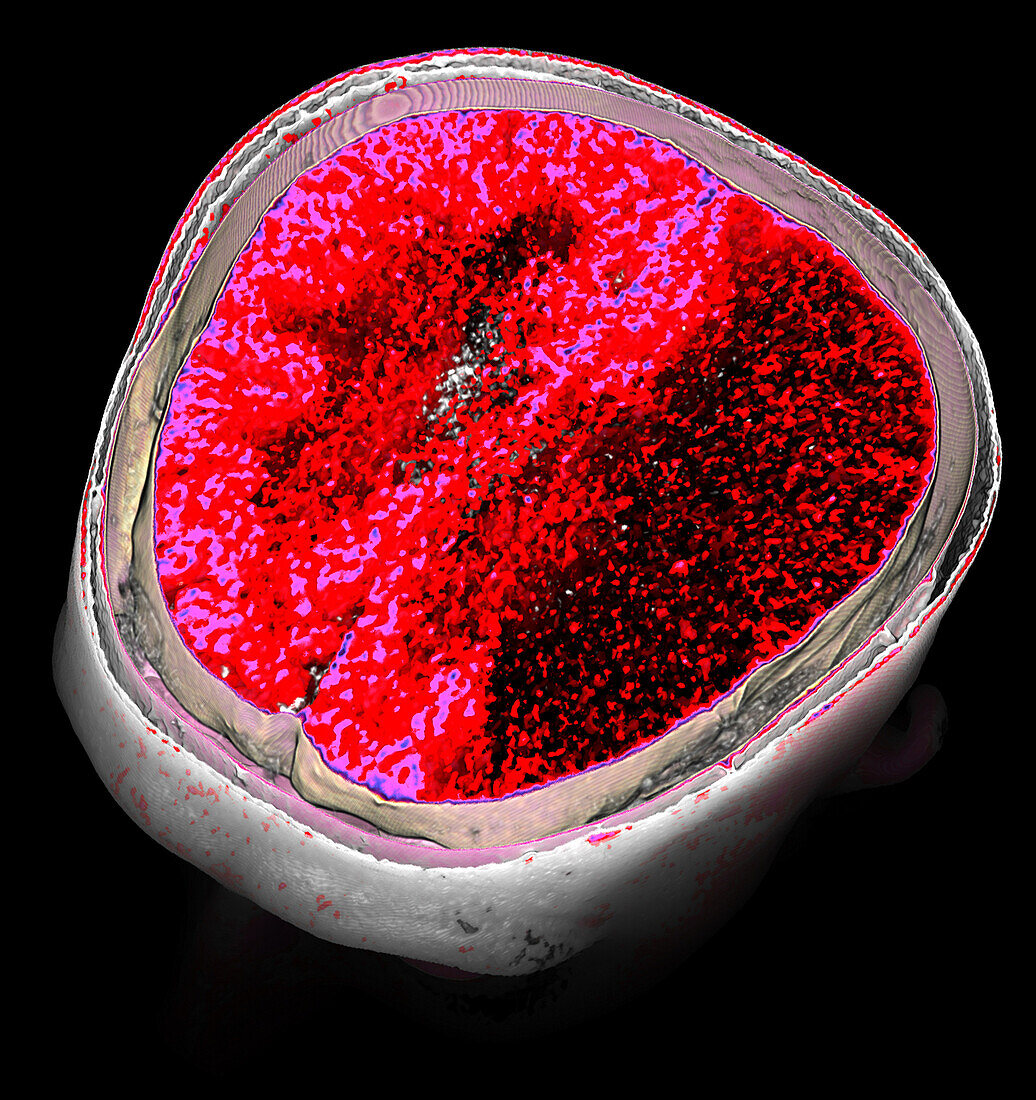 Ischaemic stroke, CT scan