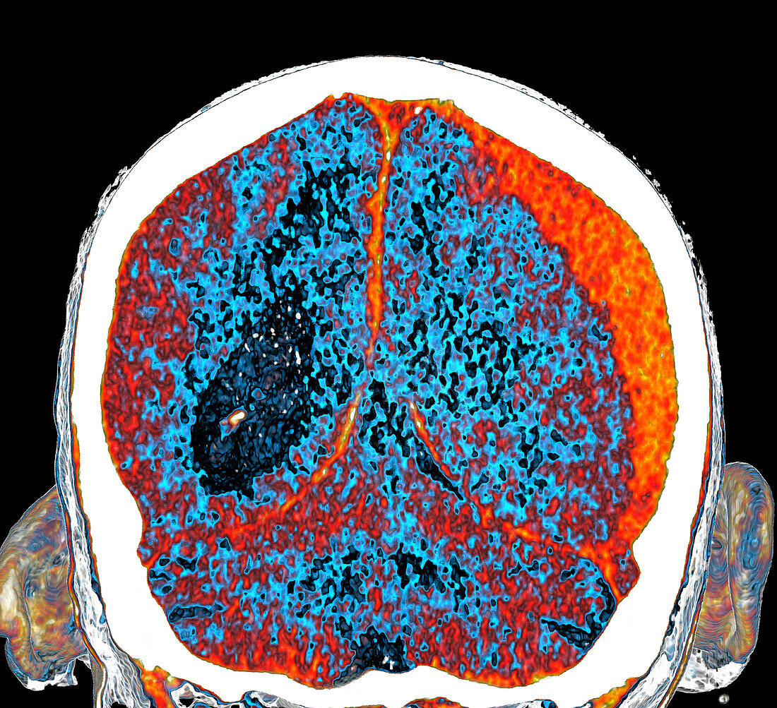 Subdural haemorrhage, CT scan