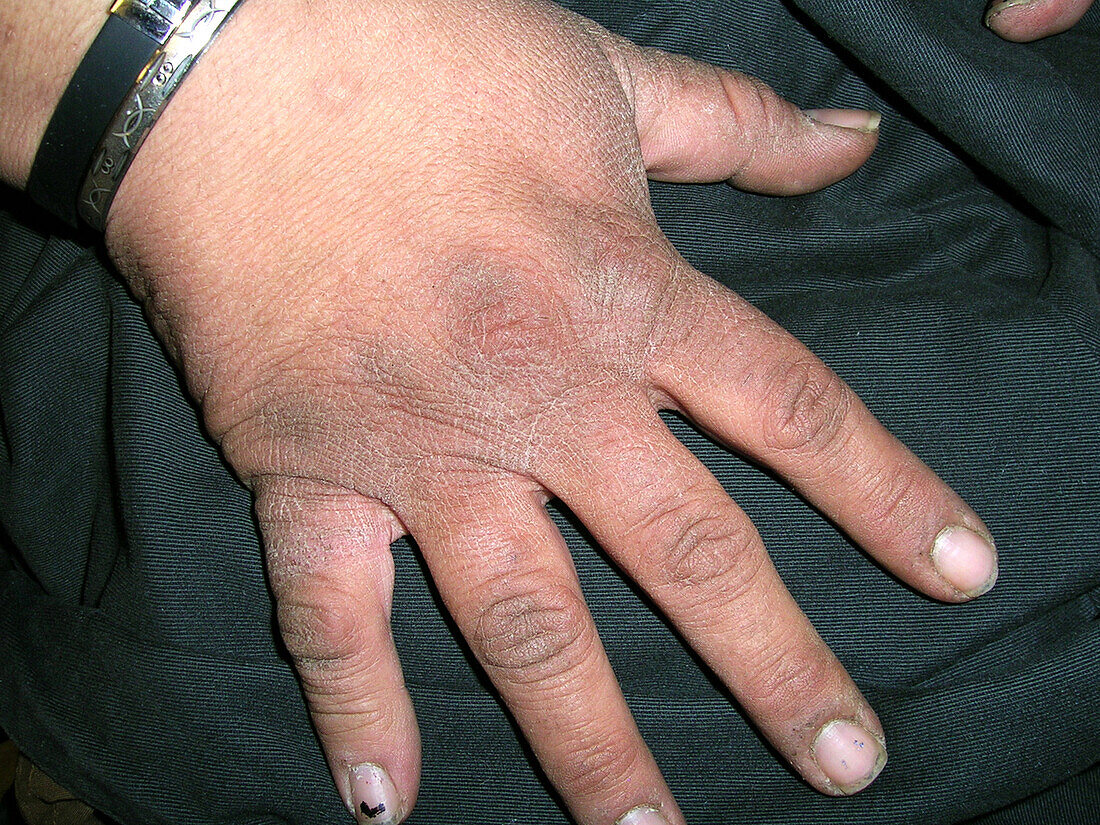 Acanthosis