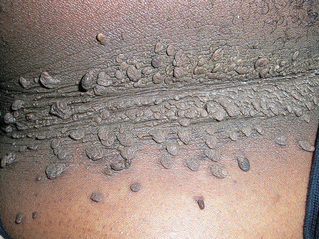 Acanthosis skin tags