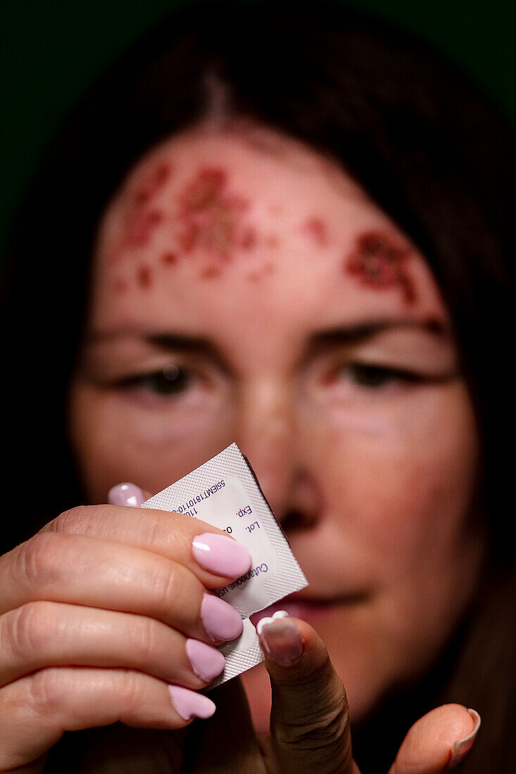 Patient with basal cell carcinoma putting on imiquimod cream