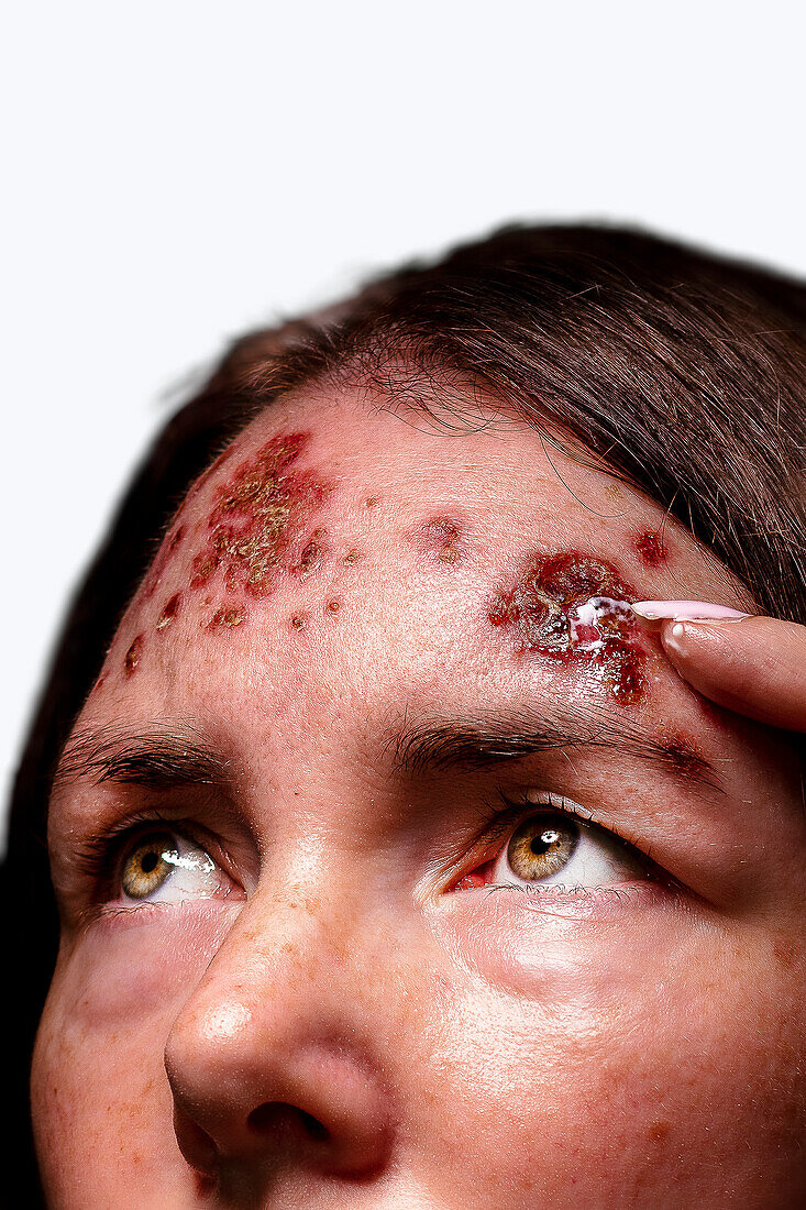 Patient with basal cell carcinoma on the forehead