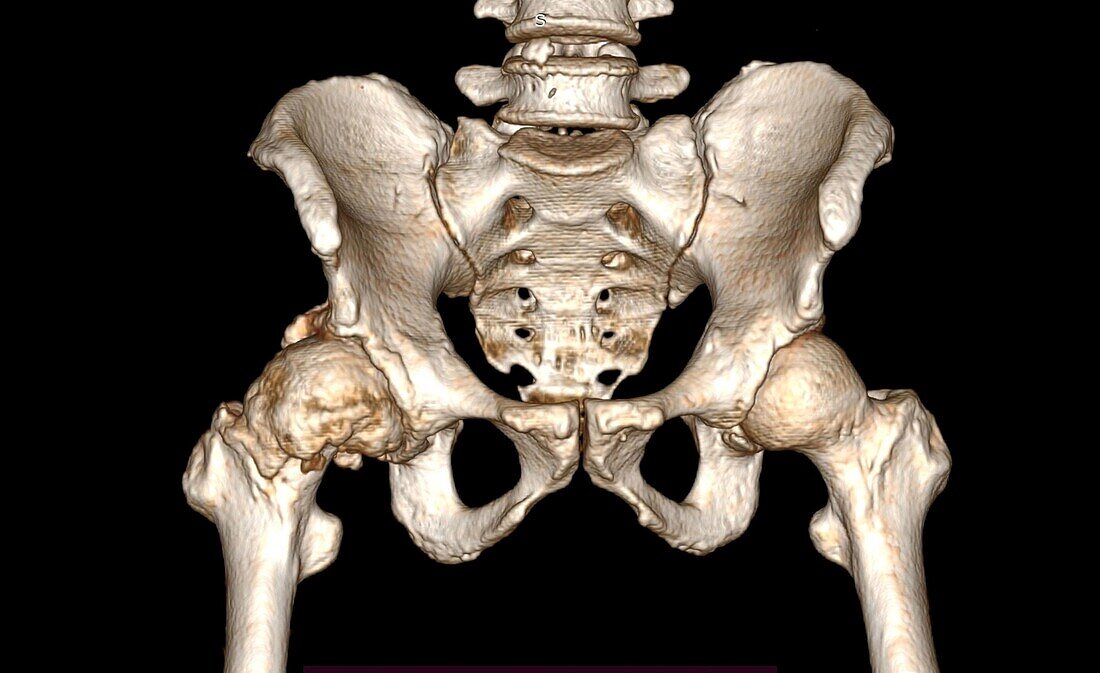 Hip osteoarthritis, CT scan
