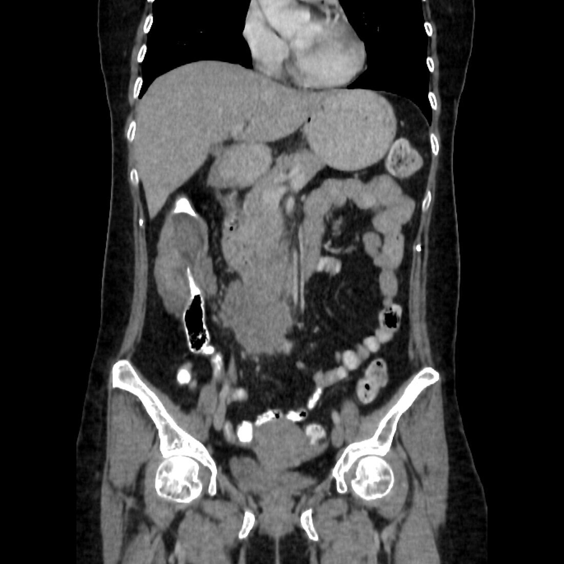 Intussusception of the intestines, CT scan