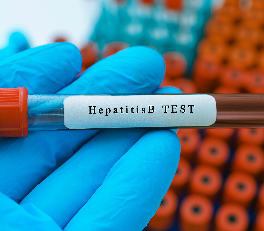 Hepatitis B virus blood test, conceptual image