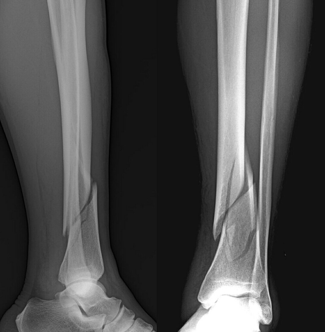 Spiral fracture of the shin, X-rays