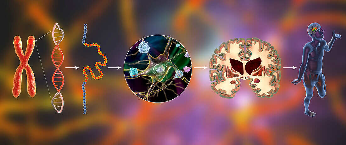Molecular genesis of Huntington's disease, illustration