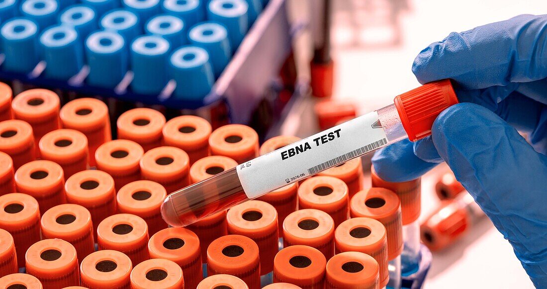 EBNA blood test, conceptual image