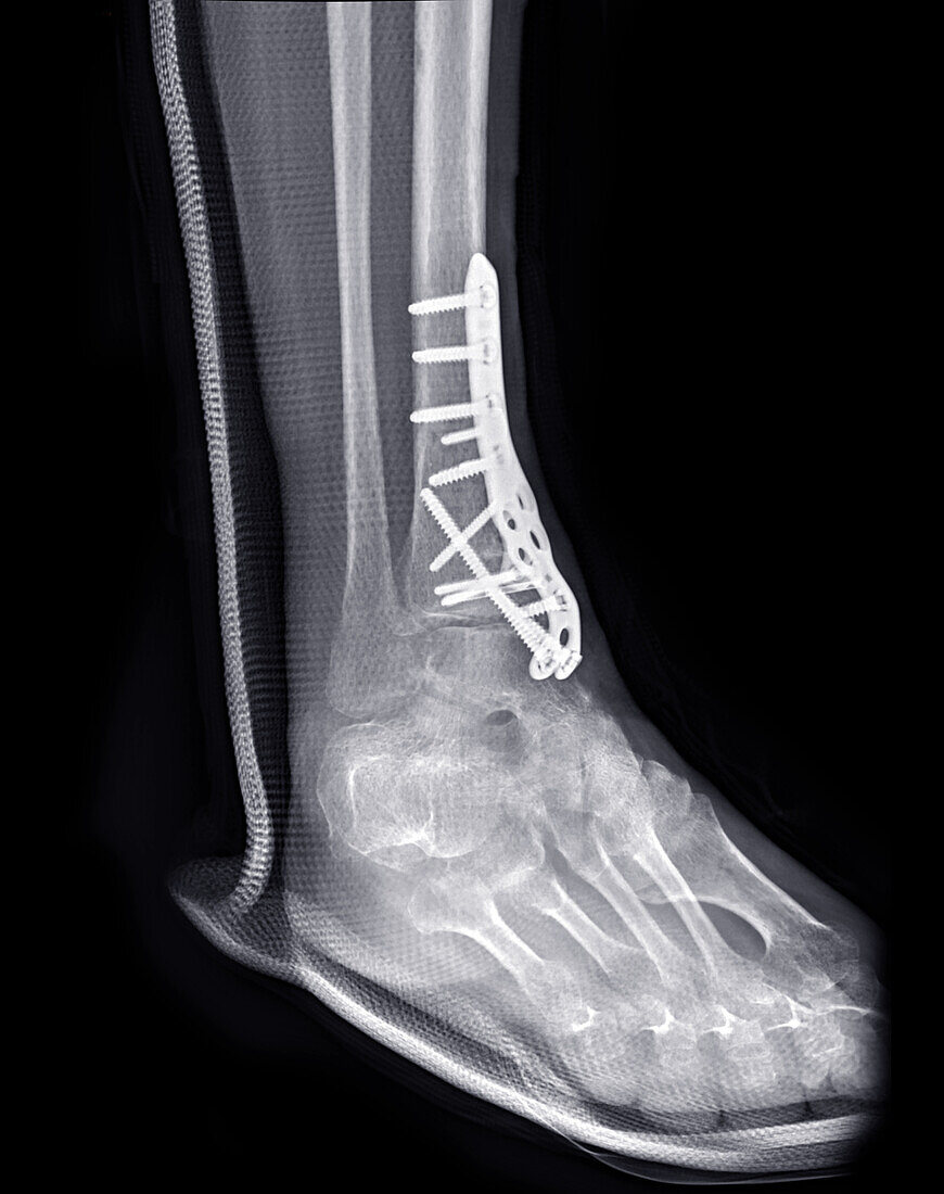 Pinned broken ankle, X-ray