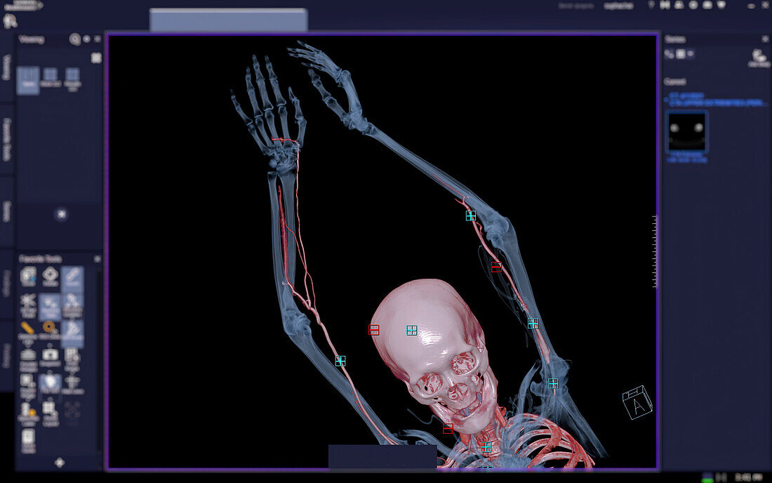Brachial arteries, 3D CT scan