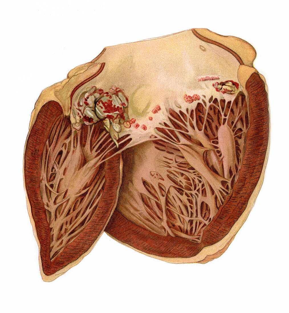Heart valve infection, illustration