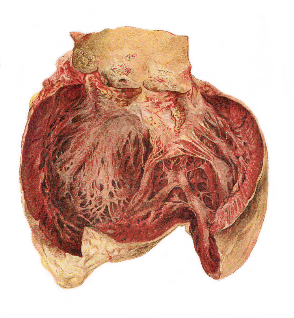 Heart disease, illustration