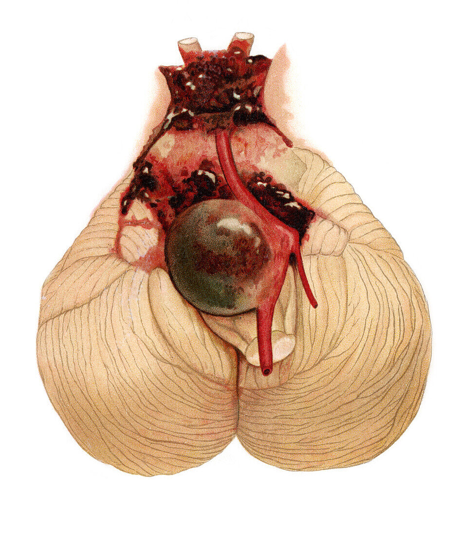 Cerebral artery aneurysm, illustration