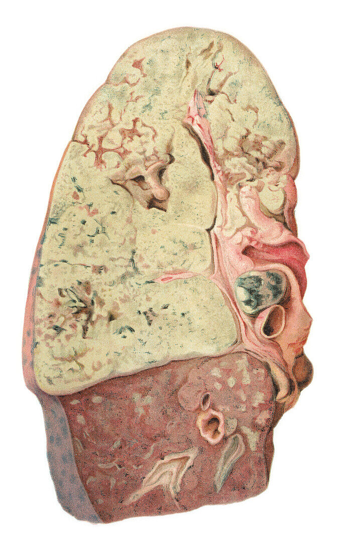 Tuberculosis of the lung, illustration