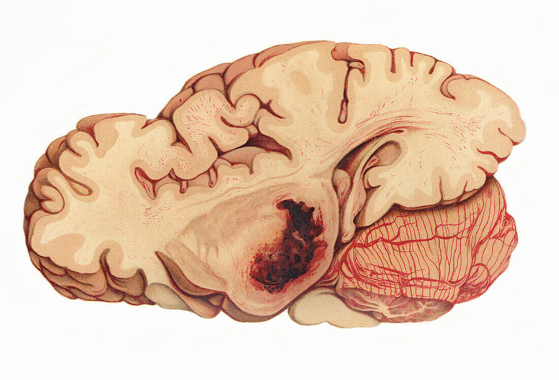 Cerebral haemorrhage, illustration