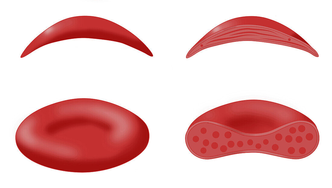 Normal blood cell and sickle cell, illustration